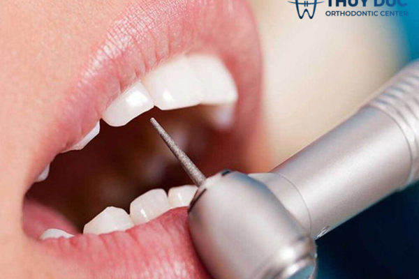 Những điều cần biết về mài kẽ trước khi niềng răng Những điều cần biết về mài kẽ trước khi niềng răng