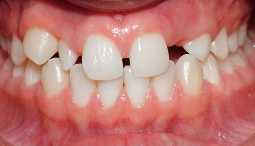 Những nhân tố nào ảnh hưởng đến việc có răng cửa thưa?
