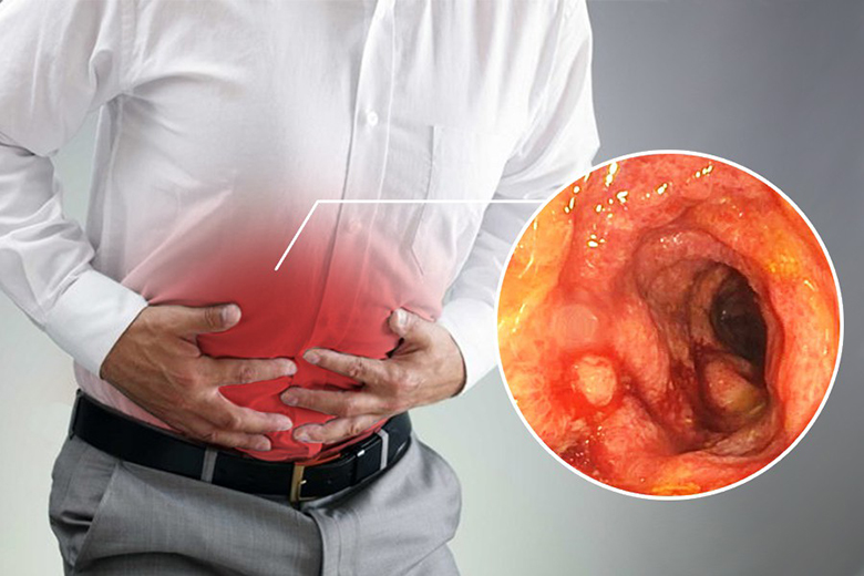 Viêm đại tràng mãn tính có chữa được không?