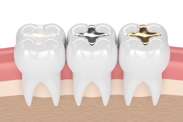 Cách trị nhức răng sau khi trám