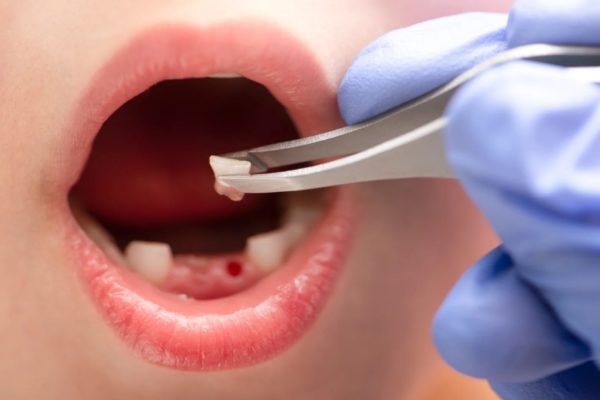 Trẻ bị gãy răng sữa có mọc lại không?