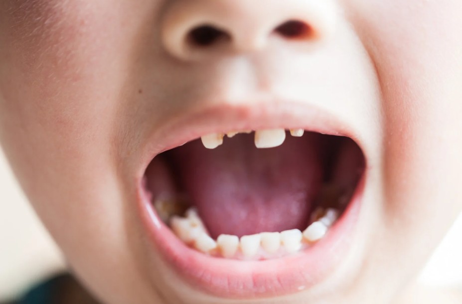 Trẻ bị sâu răng và viêm lợi – cách xử lý như thế nào?