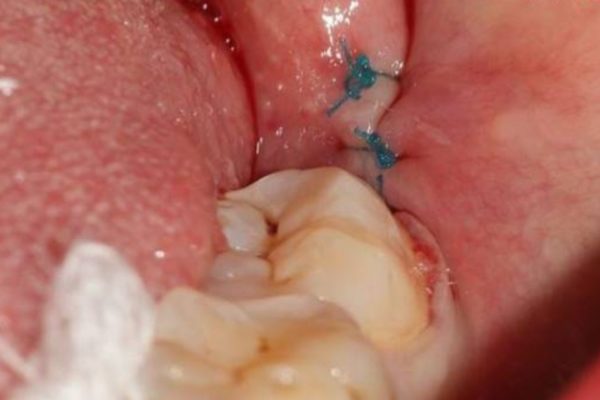 Khi nào có thể tháo chỉ khâu sau nhổ răng khôn? Khi nào có thể tháo chỉ khâu sau nhổ răng khôn?