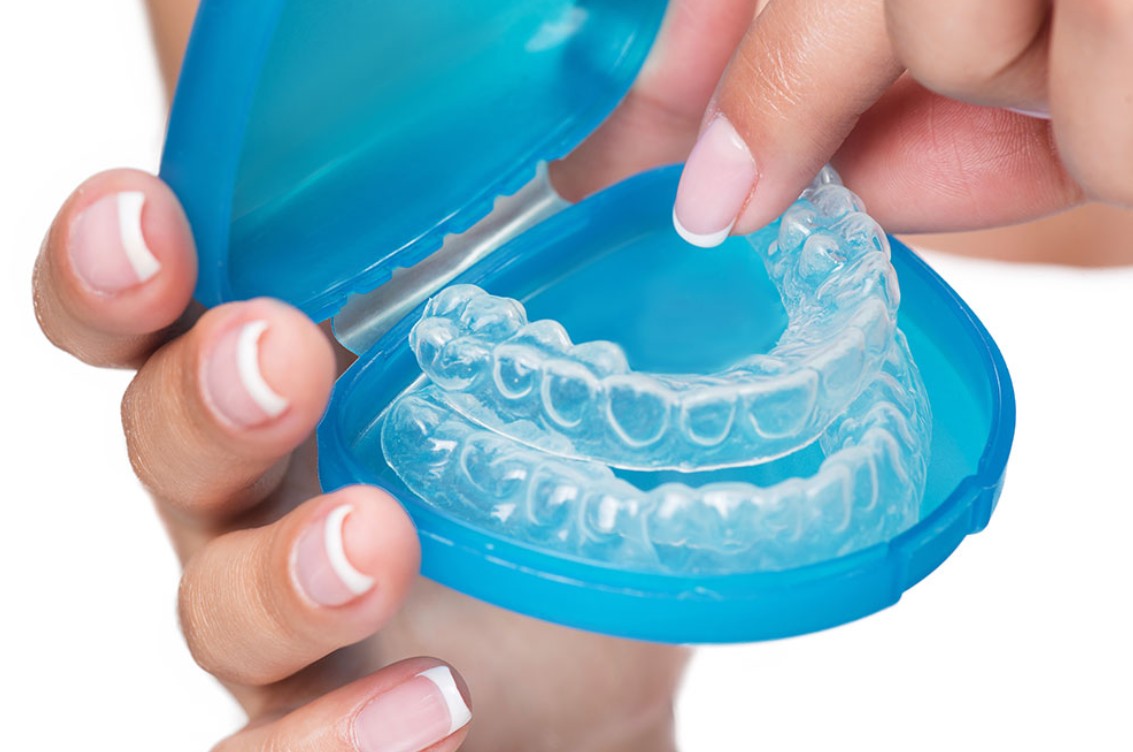 Niềng răng Invisalign có làm mòn men răng không?