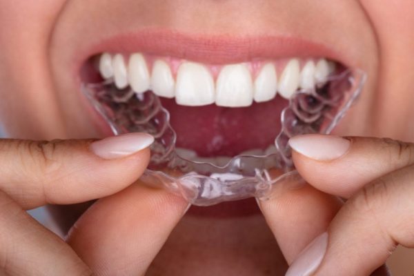 Ưu điểm của niềng răng invisalign​ là gì
