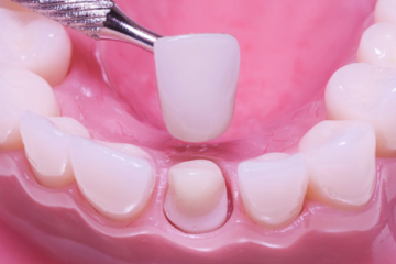 Bọc răng sứ có tốt không? Răng sứ loại nào tốt?