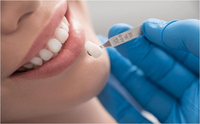 Bọc răng sứ lần 2 có được không? Khi nào cần thực hiện.