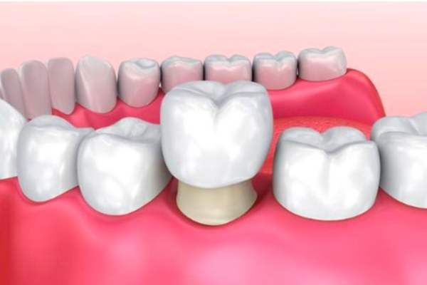 Bọc răng sứ một chiếc được không?