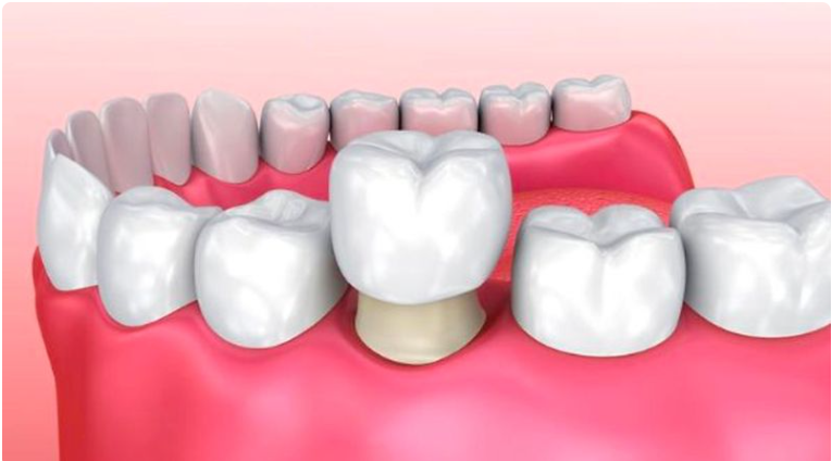 Bọc răng sứ một chiếc được không?