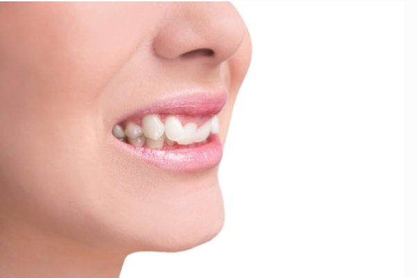 Răng lộn xộn có bọc sứ được không?