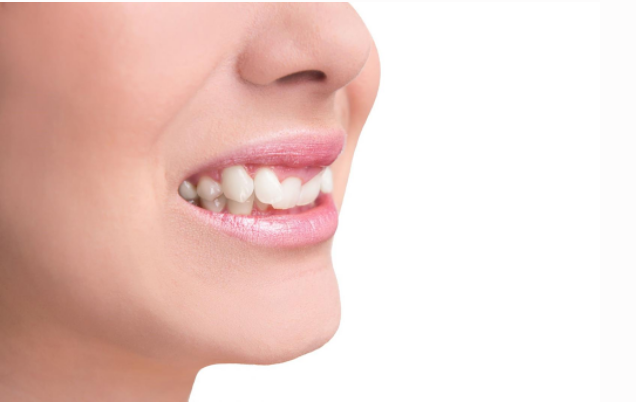 Răng lộn xộn có bọc sứ được không?