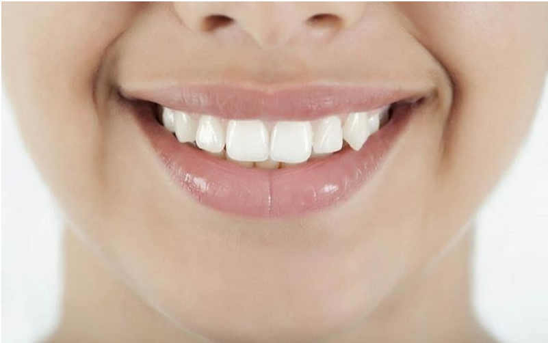 Răng khểnh có bọc sứ được không?